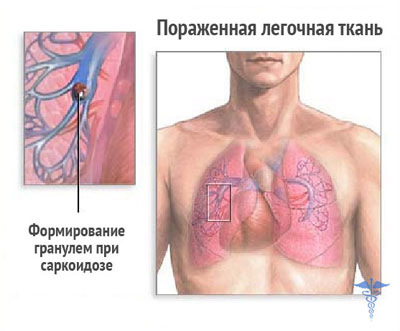 поражение легких саркоидозом поражение легких саркоидозом