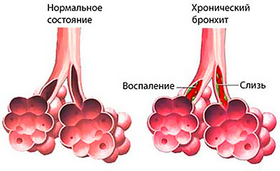 хронический бронхит хронический бронхит