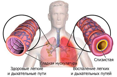 воспаление легких воспаление легких