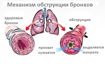 Схема бронхита Схема бронхита