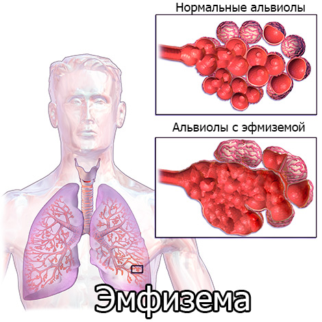 эмфизема легких рисунок эмфизема легких рисунок