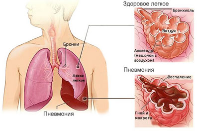 Левосторонняя пневмония Левосторонняя пневмония