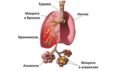 мокроты при пневмонии мокроты при пневмонии