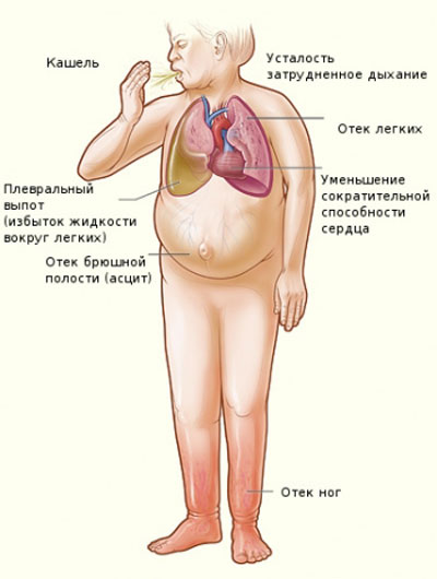 симптомы отека легких симптомы отека легких