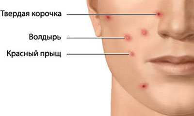 Проявление ветрянки Проявление ветрянки